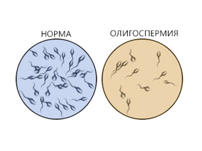 Олигозооспермия